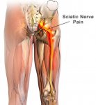 sciatic-nerve-and-nerve-pain.jpg